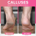 RUSTPROOF_Callus_Remover_for_Feet._Professional_Pedicure_Foot_File_(XL_Size)_Pedicure_Foot_Spa_Products,_Foot_Callus_Remover_Feet_Scrubber_for_Dead_Skin,_Wet_&_Dry_Use,_Non_Electric_Foot_Care_Kit